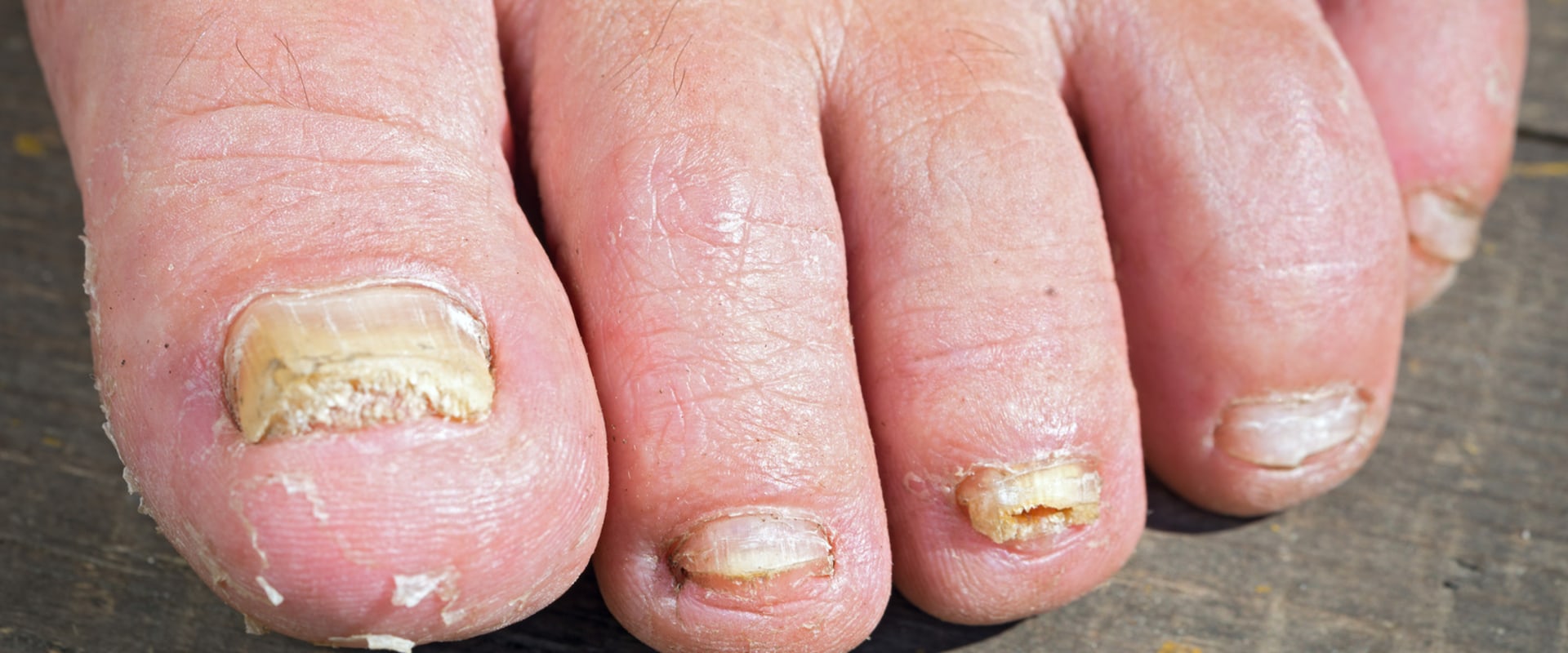 Swimming with Toenail Fungus Is it Safe? (Revised)