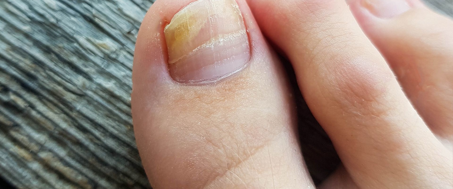 What are the Side Effects of Toenail Fungus Treatment?