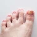 What Causes Toenail Fungus? - A Comprehensive Guide