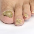What is the strongest fungal nail treatment?