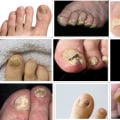 How to Identify, Treat and Prevent Toenail Fungus