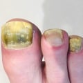 Can Toenail Fungus Cause Serious Health Problems?