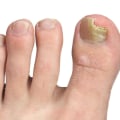 When should you see a dr for toenail fungus?
