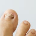 Can you get rid of toenail fungus forever?