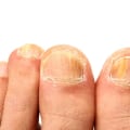 What are the common signs of a fungal toenail infection?