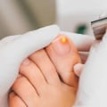 Is it Safe to Wear Socks While Treating Toenail Fungus?