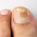 Does vicks really work on toenail fungus?
