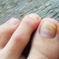Treating Toenail Fungus: The Best Solutions for Healthy Nails