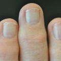What are 3 signs of a fungal nail infection?