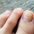 Is it Safe to Wear Open-Toed Shoes with Toenail Fungus? - An Expert's Guide