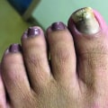 Can Listerine Really Help Treat Toenail Fungus?