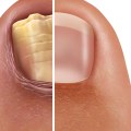 Home Tests for Diagnosing Toenail Fungus: A Comprehensive Guide
