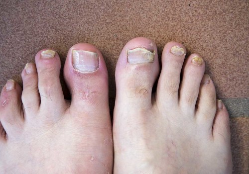 What is the fastest way to cure toenail fungus?