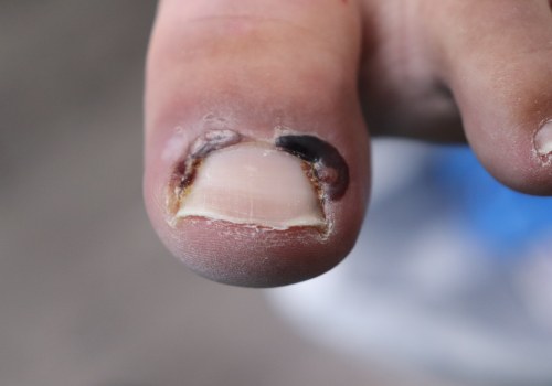What are the Risks of Toenail Fungus? - A Comprehensive Guide