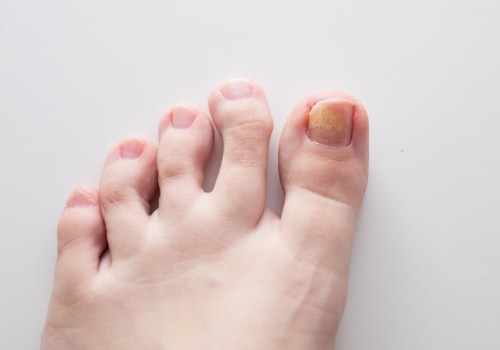 What Causes Toenail Fungus? - A Comprehensive Guide