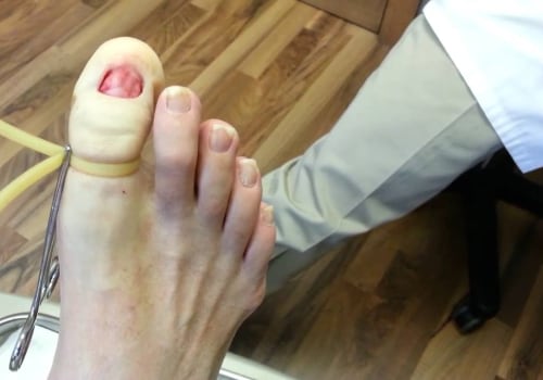 How to Get Rid of Toenail Fungus Permanently