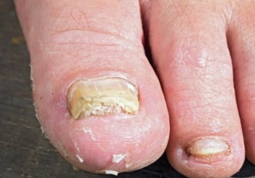 Can Coconut Oil Treat Toenail Fungus? - A Comprehensive Guide
