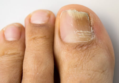 The Connection Between Toenail Fungus and Gut Health