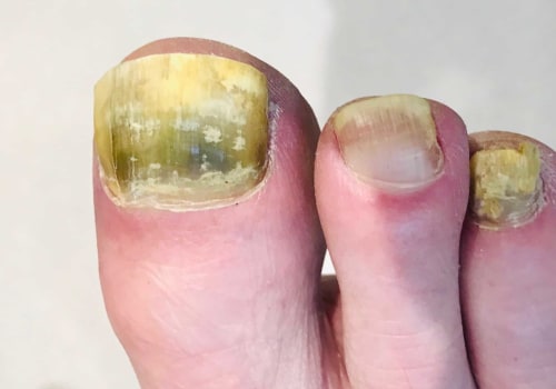Can Toenail Fungus Cause Serious Health Problems?