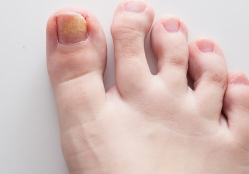 Can Toenail Fungus Go Away on Its Own? - An Expert's Perspective