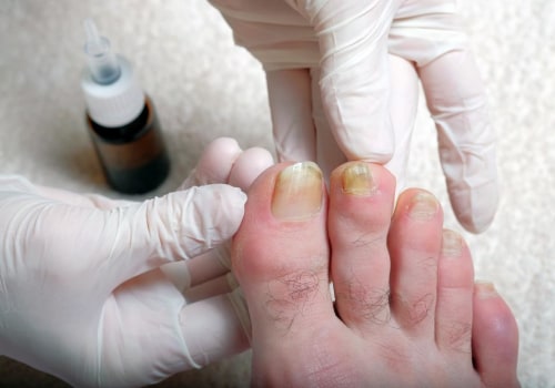 Is toenail fungus related to diet?