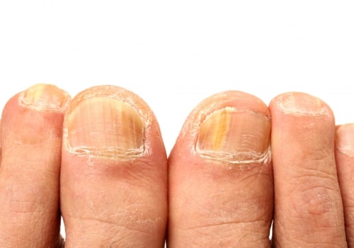 What are the common signs of a fungal toenail infection?
