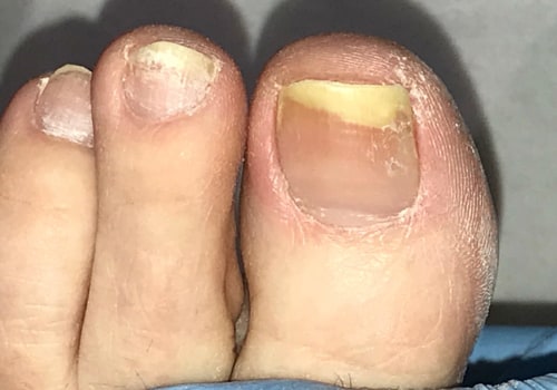What kills toenail fungus?