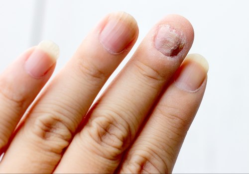 Do Over-the-Counter Toenail Fungus Medications Work?