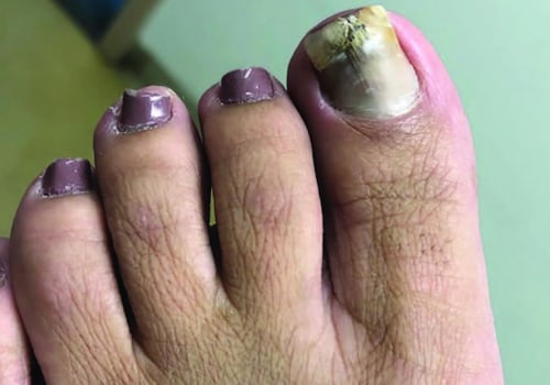 Can Listerine Really Help Treat Toenail Fungus?